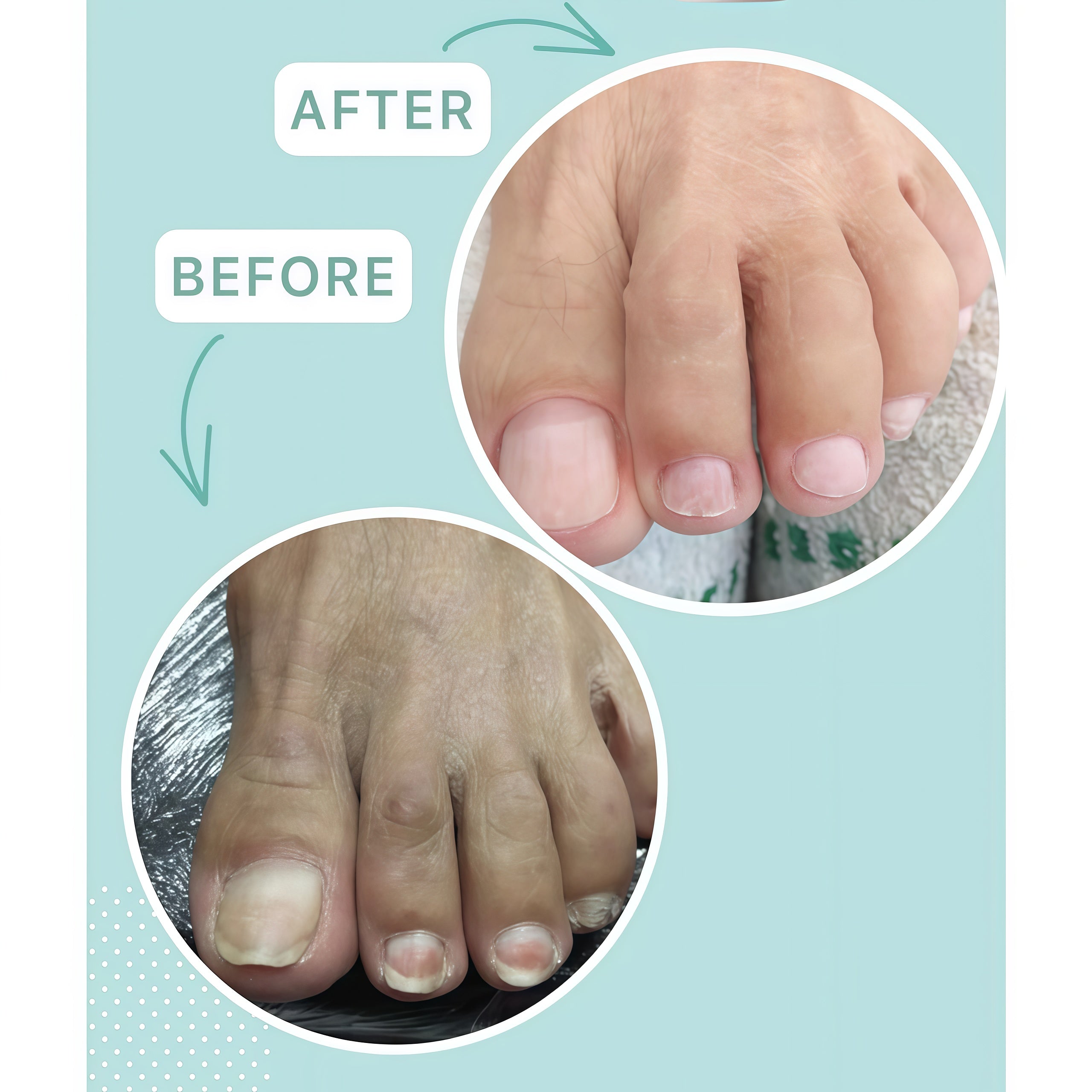 Shelly Restorative Nail Oil for Weakened & Delamination-Prone Nails with Farnesol & Tea Tree - 30 ml | Stop Onycholysis Nail Recovery Oil